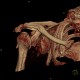 Comminuted fracture of the head of humerus, VRT: CT - Computed tomography